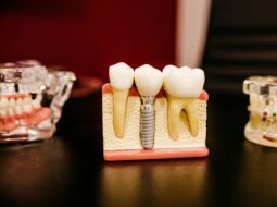 Dental Implants